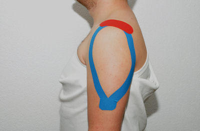 Kinesio Taping Therapie